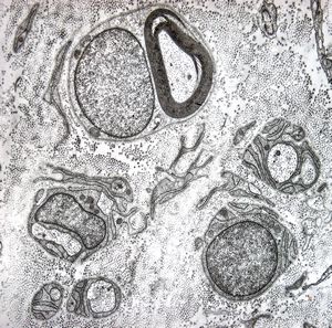 n.suralis - hypertrophic demyelinizing neuropathy n.suralis - hypertrophic demyelinizing neuropathy